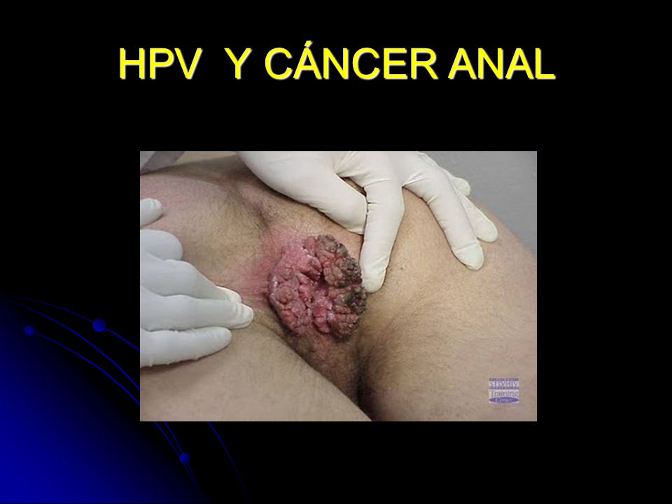 Hpv anal cancer